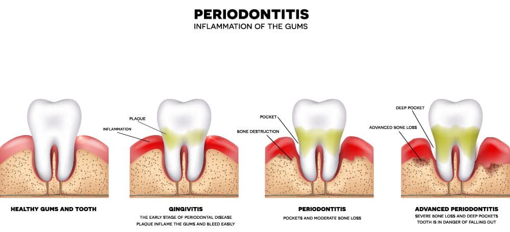 A diagram of four stages of gum disease and periodontitis