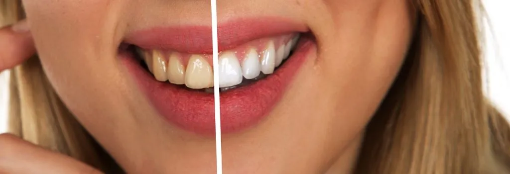 Before and after teeth whitening results