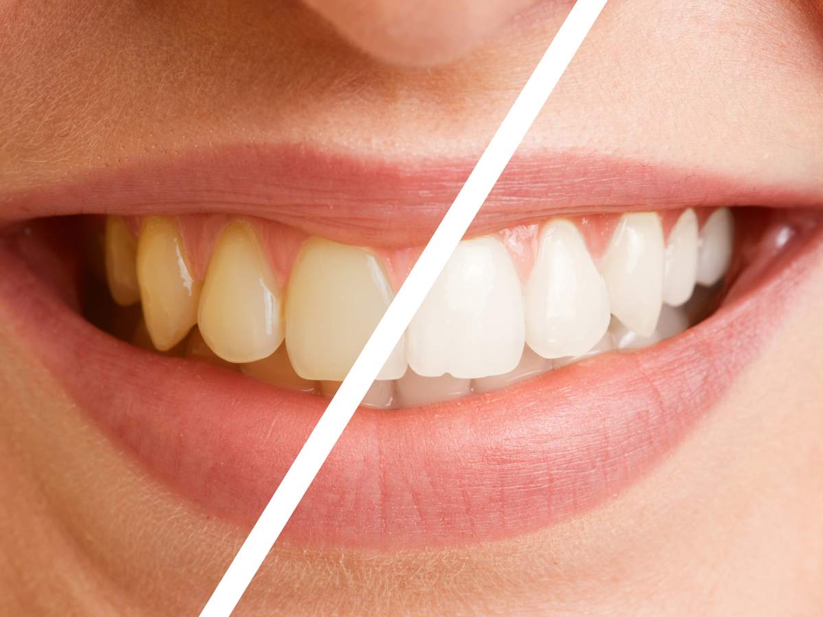 teeth cleaning dentist in tacoma wa before and after dental teeth cleaning close up of teeth