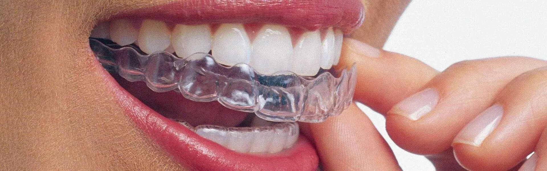 A patient putting in Invisalign Aligners