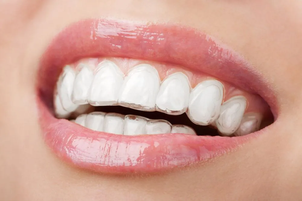 Smiling with Invisalign Aligners