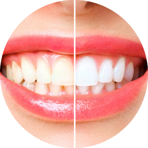 Teeth Whitening