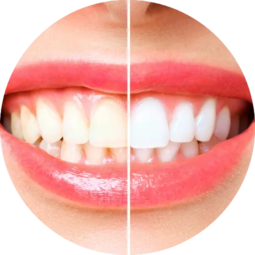 Teeth Whitening